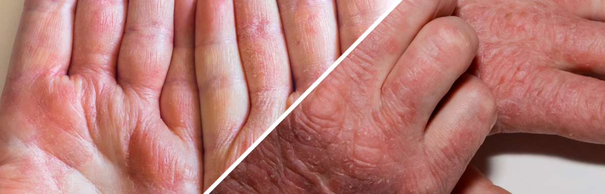 Illustration showing the differences between eczema and psoriasis. Learn about the symptoms, causes, and treatments.