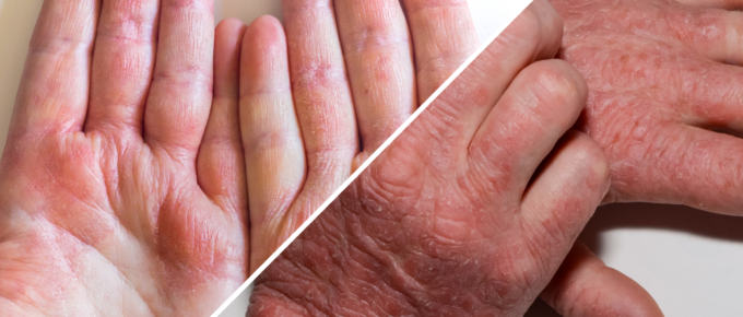 Illustration showing the differences between eczema and psoriasis. Learn about the symptoms, causes, and treatments.