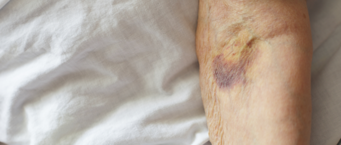 Unexplained Bruising on Hands & Arms? Learn About Solar Purpura