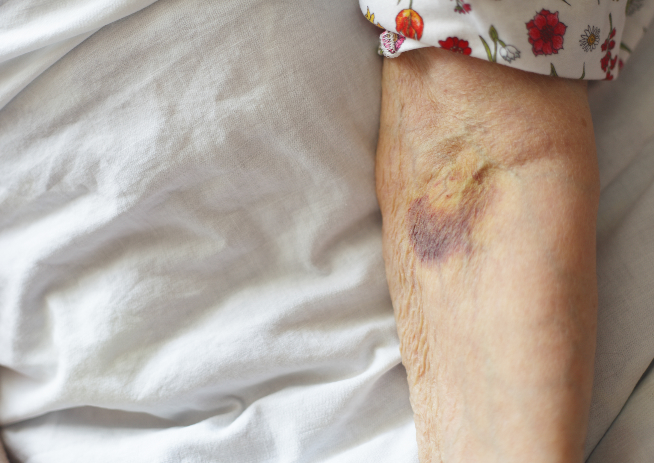 Unexplained Bruising on Hands & Arms? Learn About Solar Purpura