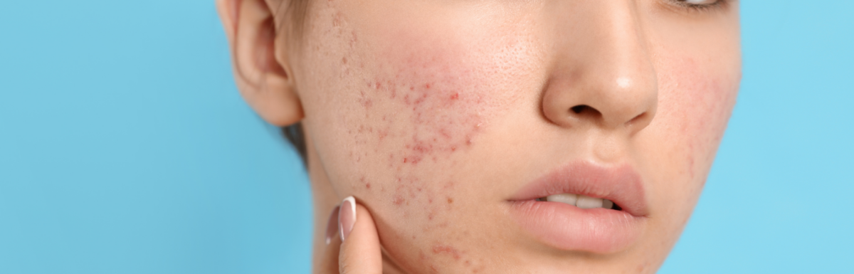 Surprising Habits that Could Be Causing Your Acne Flares