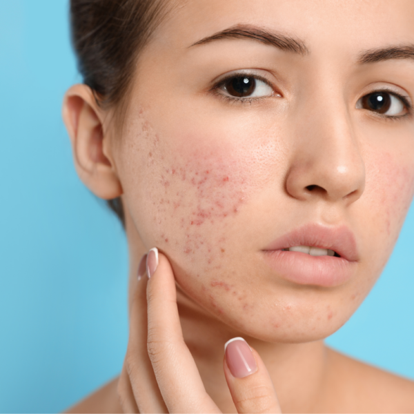 Surprising Habits that Could Be Causing Your Acne Flares