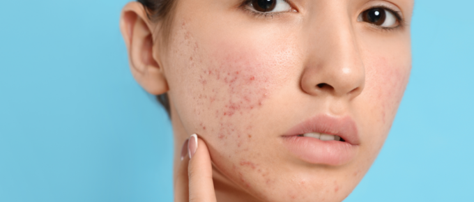 Surprising Habits that Could Be Causing Your Acne Flares