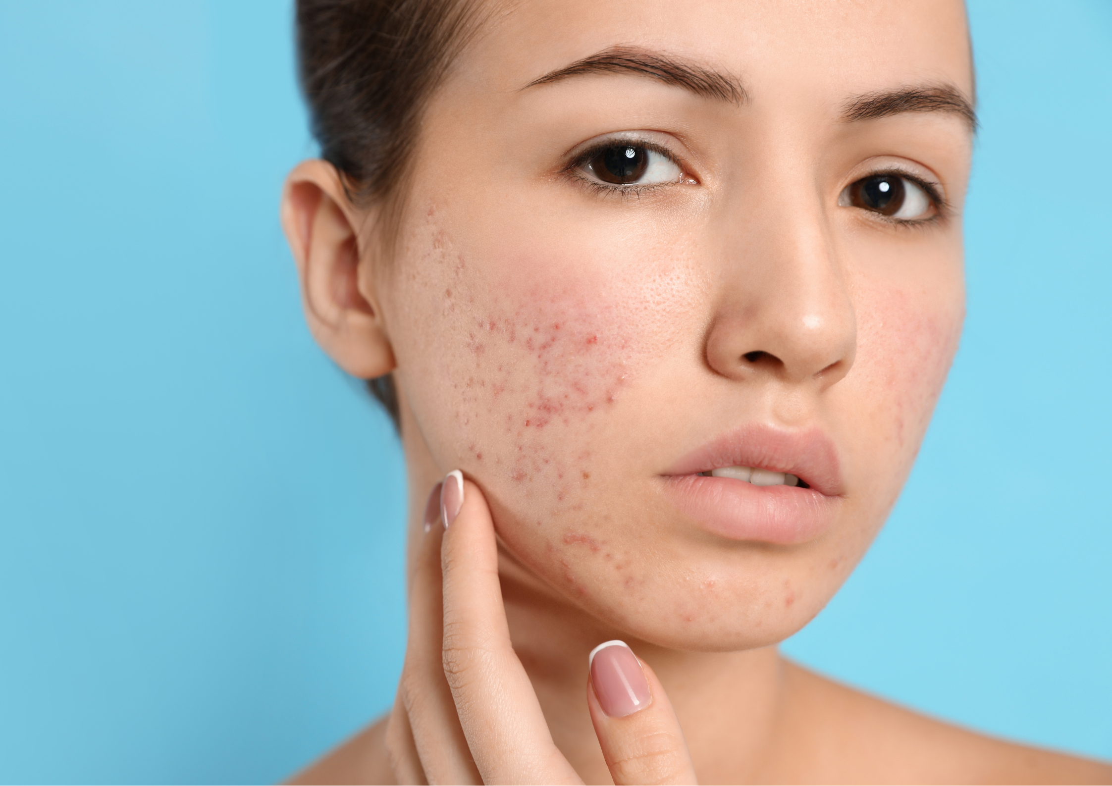 Surprising Habits that Could Be Causing Your Acne Flares