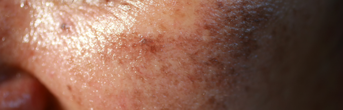 Laser Dark Spot Removal: How Effective is It?