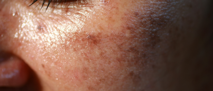 Laser Dark Spot Removal: How Effective is It?