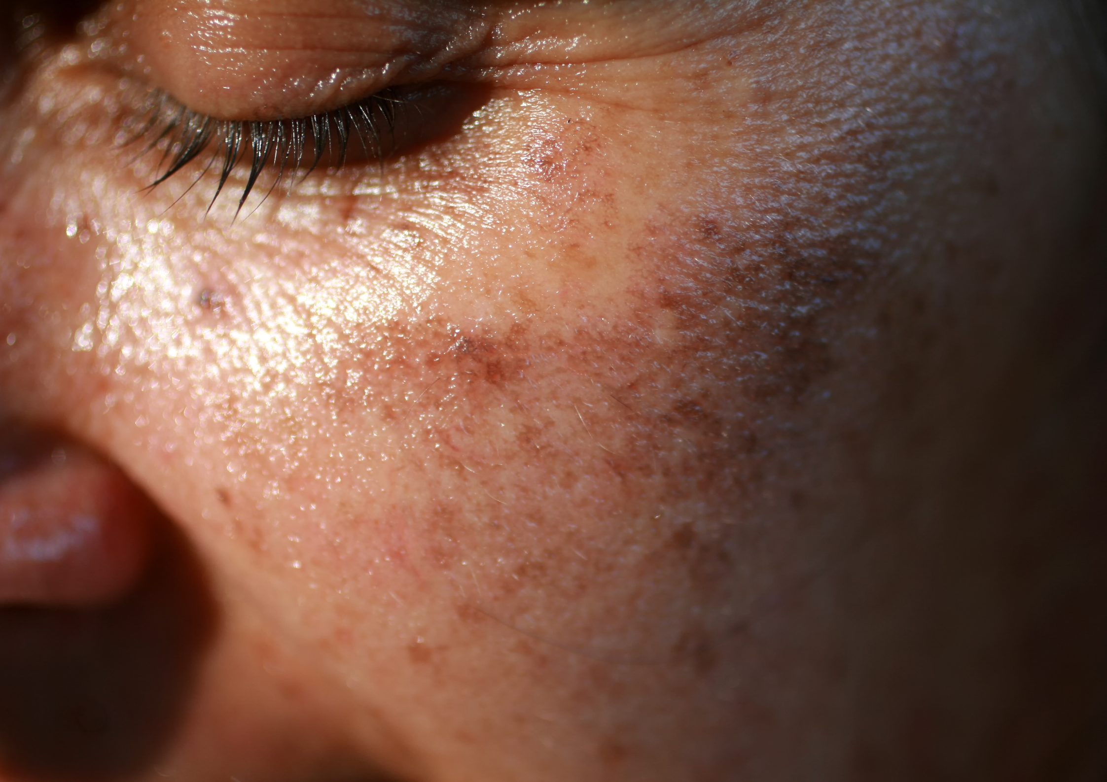 Laser Dark Spot Removal: How Effective is It?