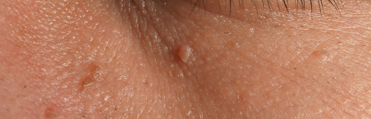 Warts vs Moles vs Skin Tags: What's the Difference?