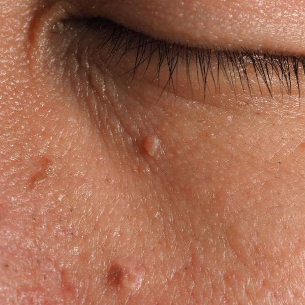 Warts vs Moles vs Skin Tags: What's the Difference?