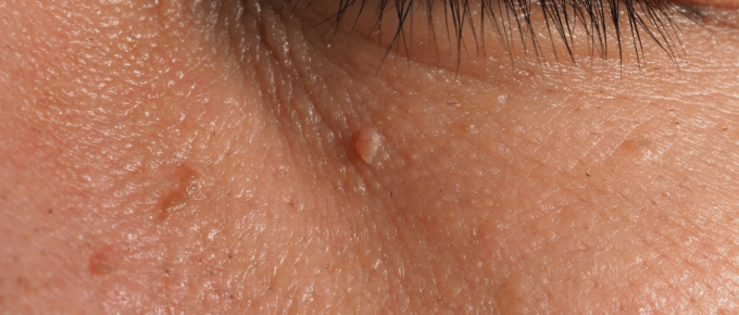 Warts vs Moles vs Skin Tags: What's the Difference?