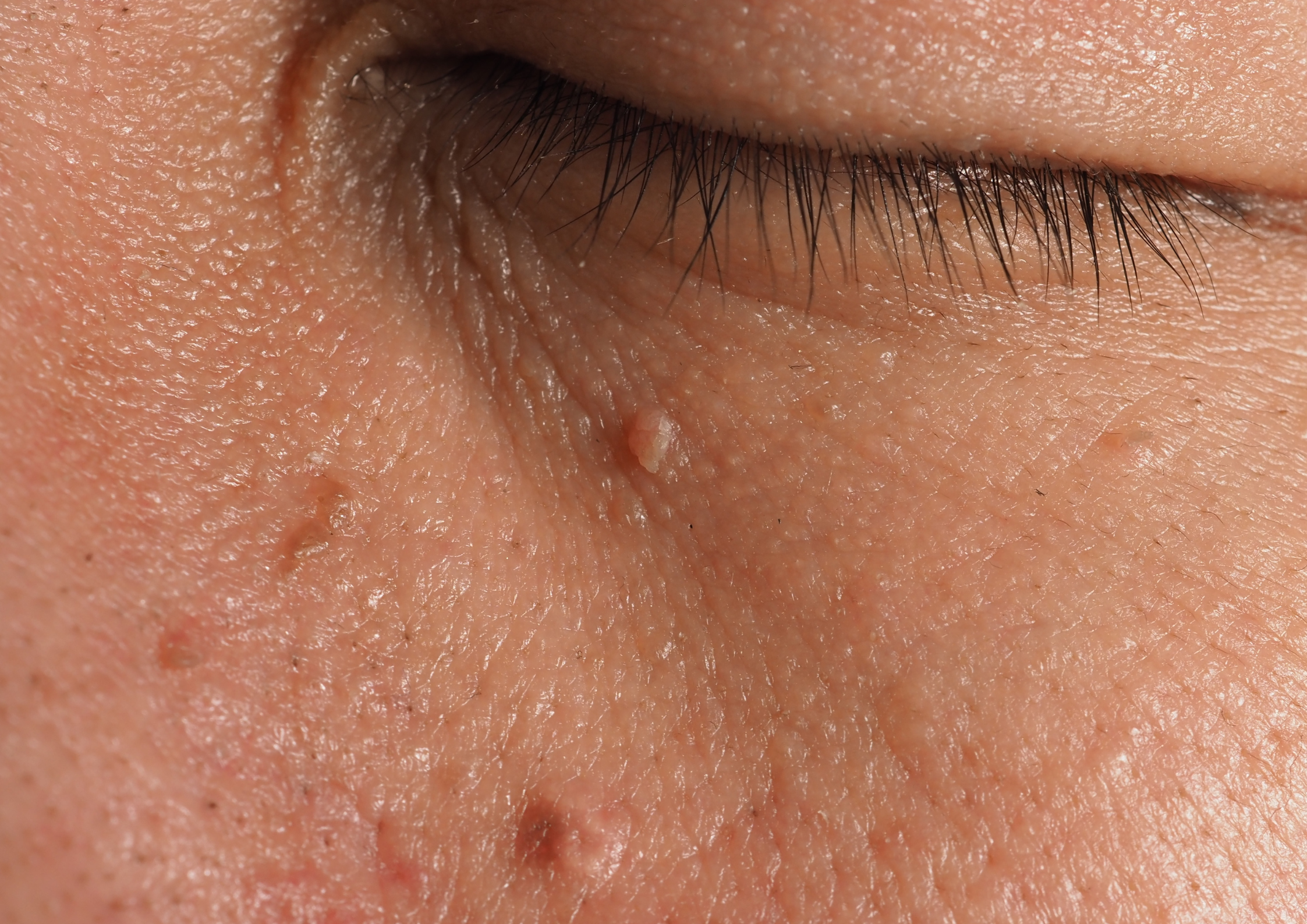 Warts vs Moles vs Skin Tags: What's the Difference?