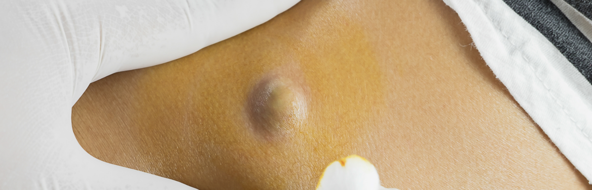 When Should You See a Dermatologist for Skin Cysts?