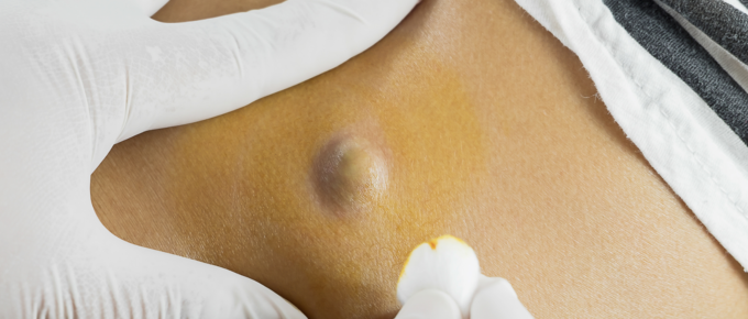 When Should You See a Dermatologist for Skin Cysts?