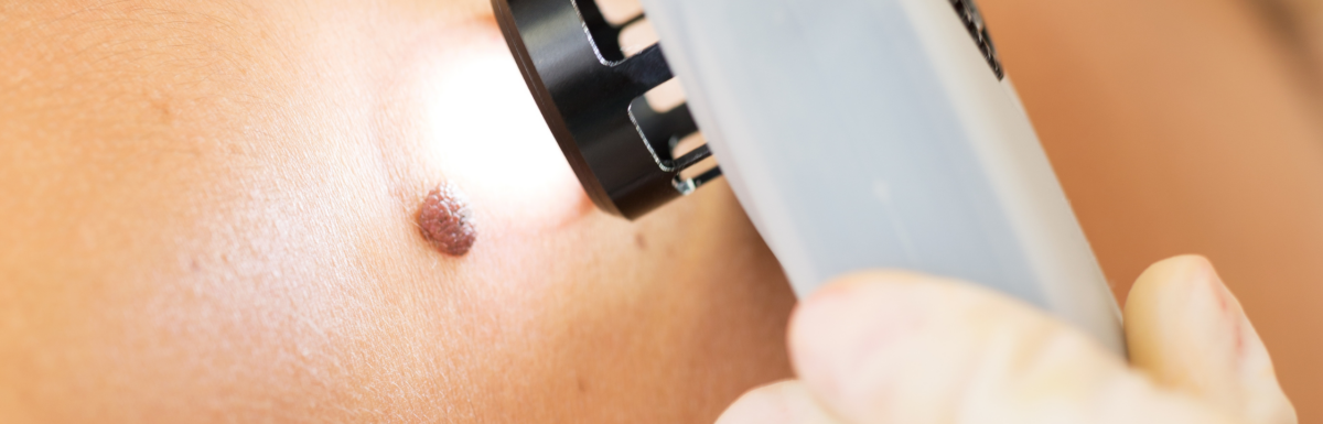 Melanoma Awareness Month: What to Watch For This Year