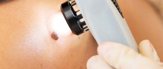 Melanoma Awareness Month: What to Watch For This Year