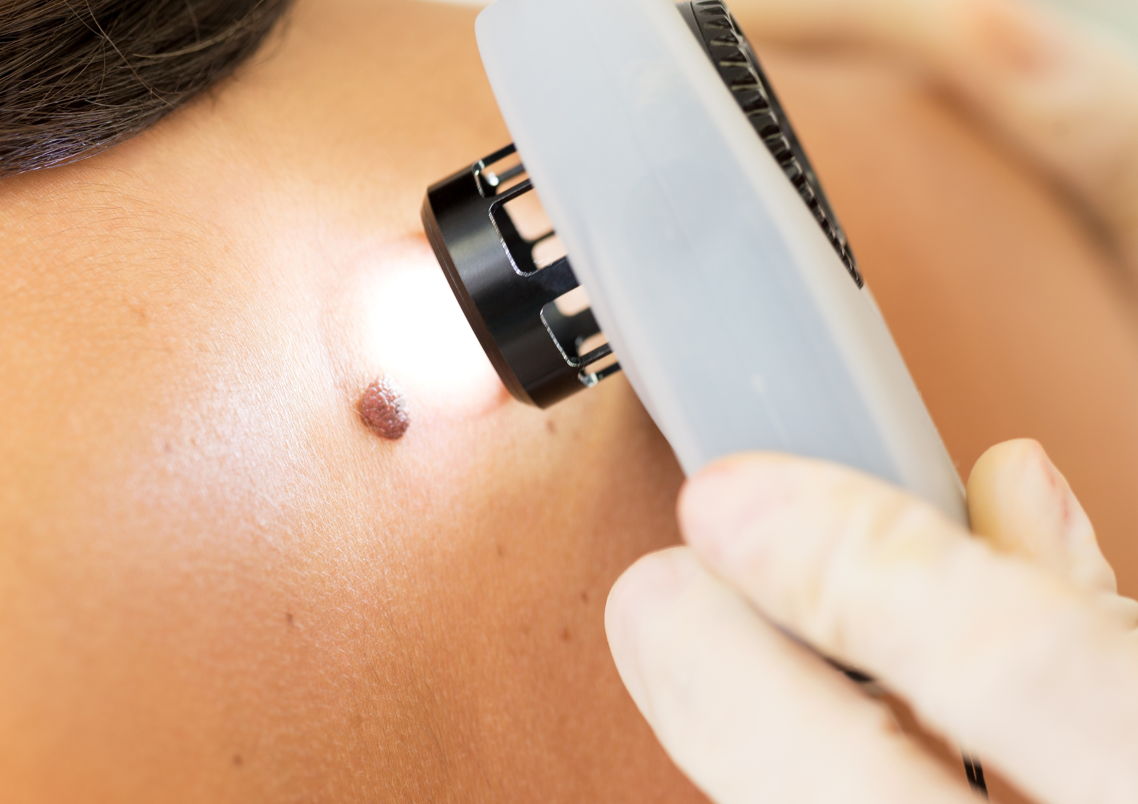 Melanoma Awareness Month: What to Watch For This Year